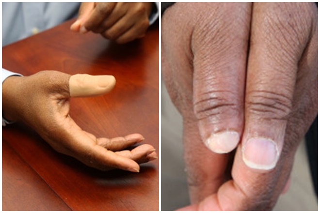 Boateng at times wears a fake thumb over his disfigured thumb. (Image: NYPost)